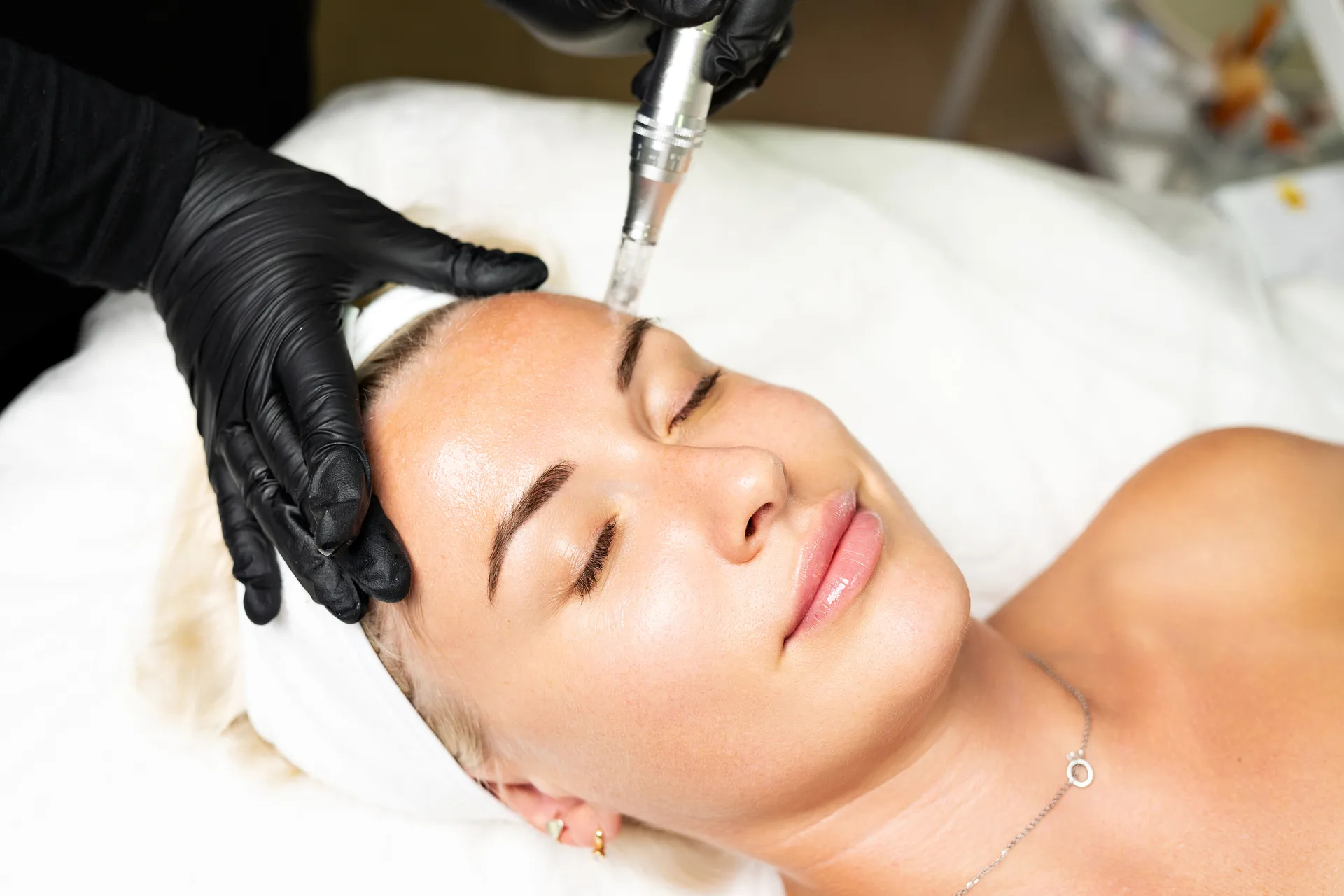 Microneedling at Younger You Aesthetics — Northern California