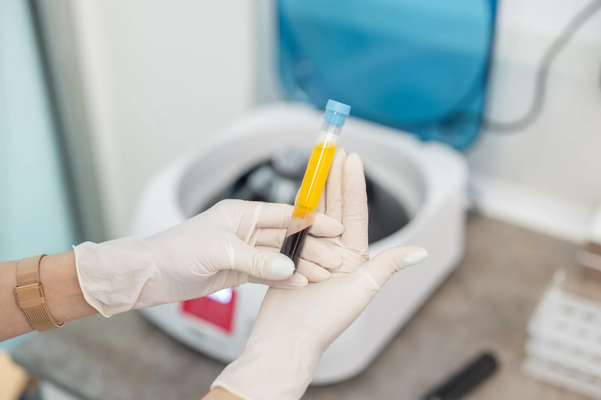 Microneedling with PRF at Younger You Aesthetics — Northern California