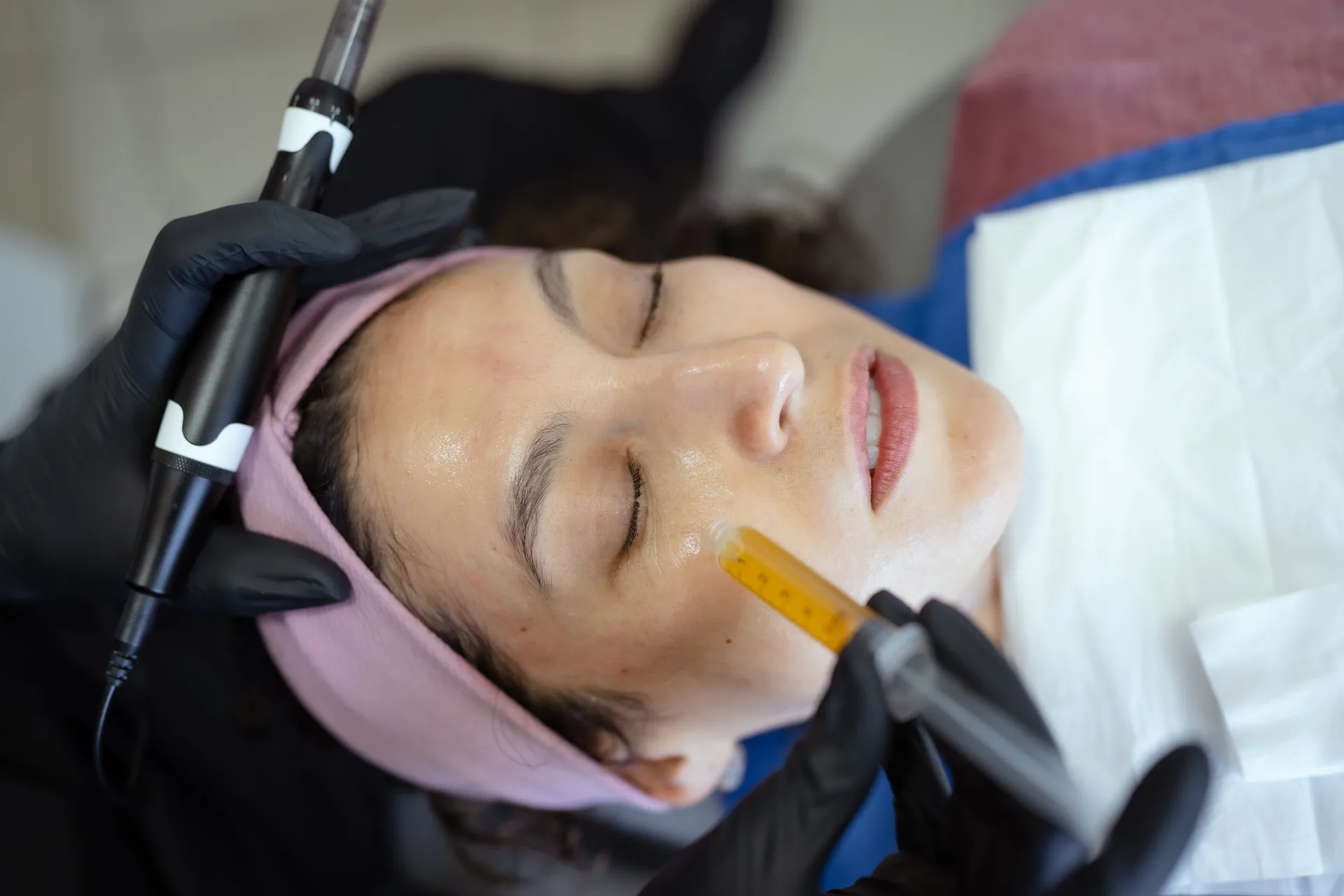 Microneedling with PRF — overview